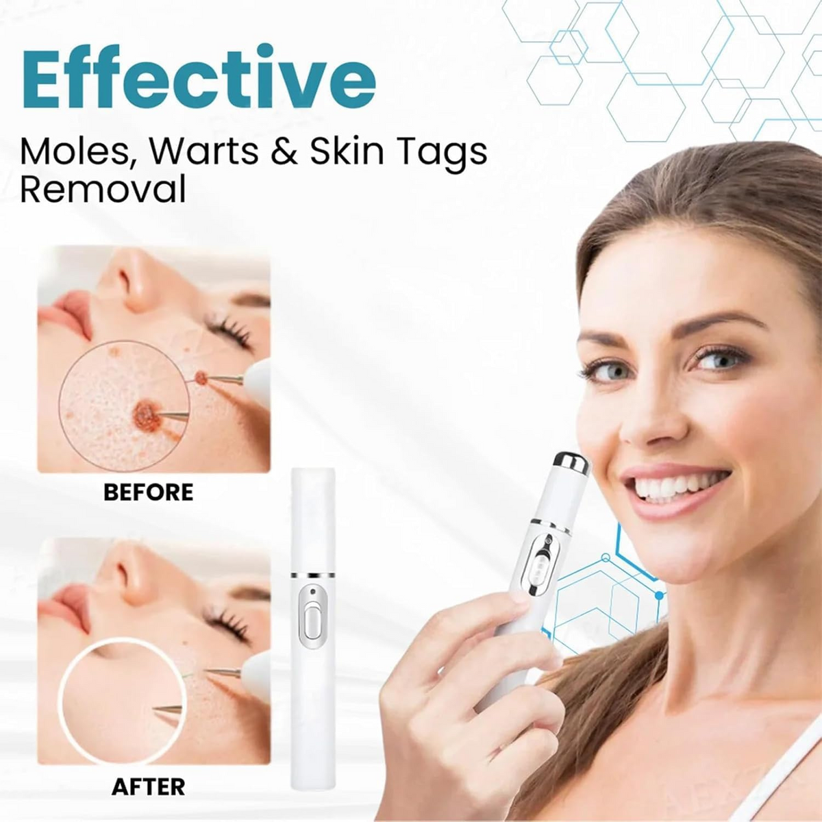 Non-Invasive Mole and Wart Removal Laser Pen